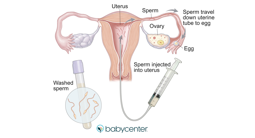 Can You Inject Sperm With a Turkey Baster